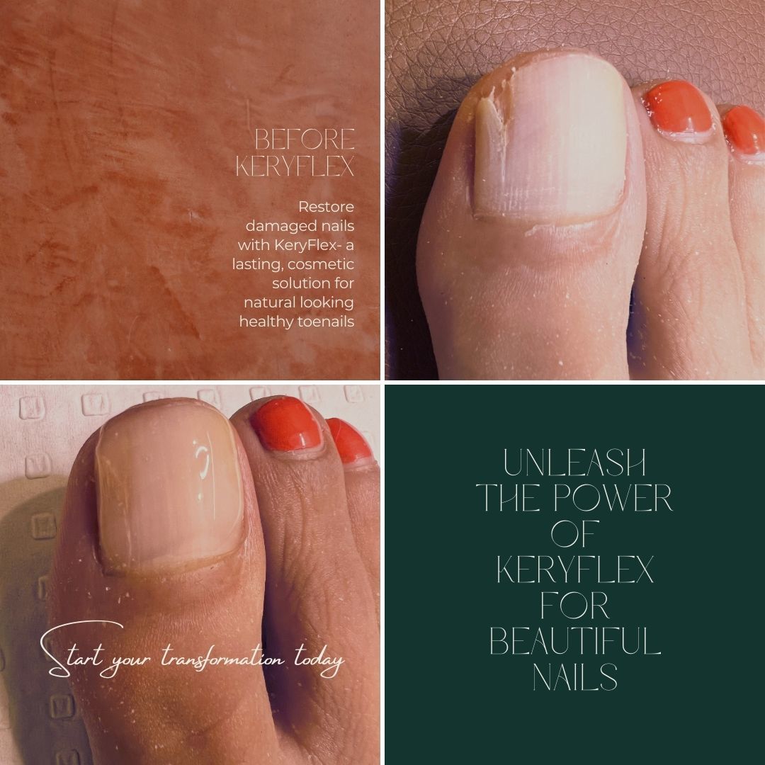 Keryflex Results Before and After