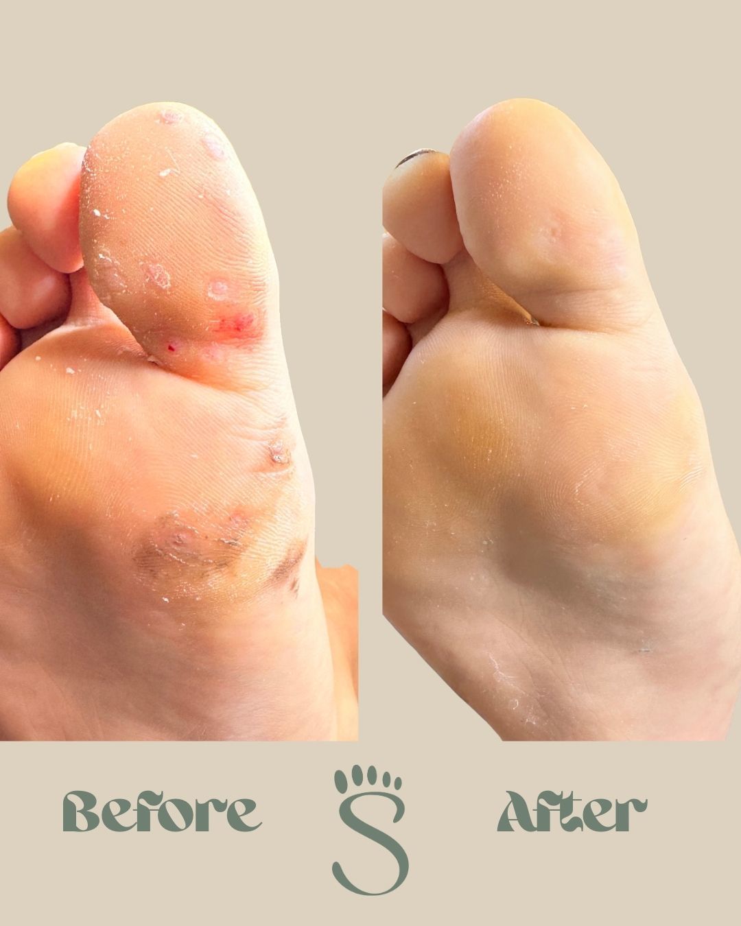 SWIFT results 12 week followup Sydney Podiatry Co