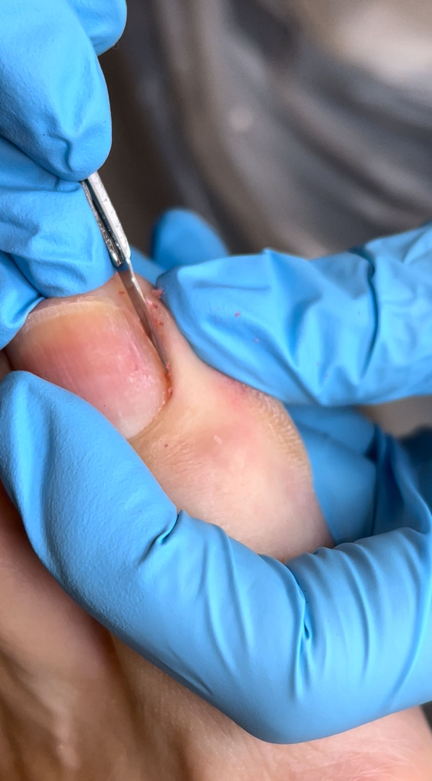 podiatrist performing gentle ingrown toenail treatment at Sydney Podiatry Co in Balgowlah